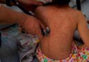 Detectan 362 casos de sarampión en México