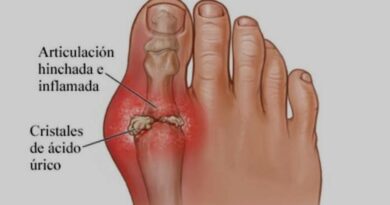 La gota: mitos y realidades de esta enfermedad artrítica